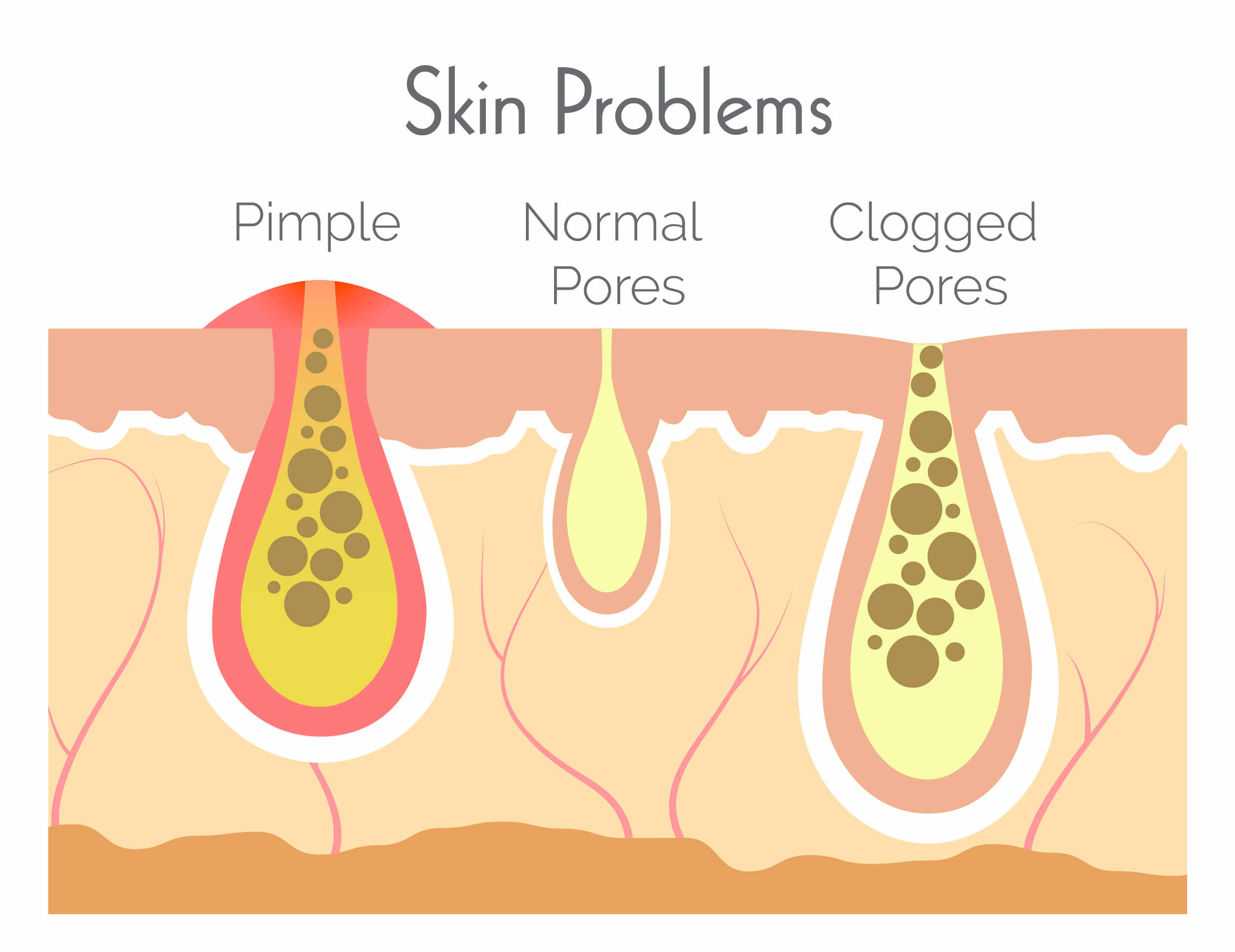 Infographic on skin problems and clogged pores