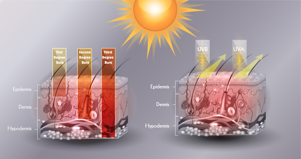 Artist illustration of UV rays penetrating layers of the skin