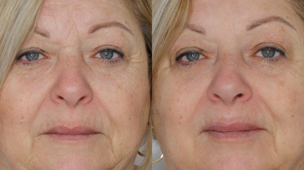 Closeup of woman before and after facial treatment